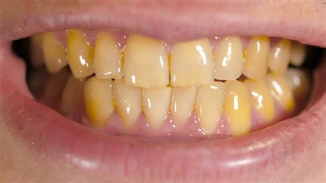 Желтые зубы