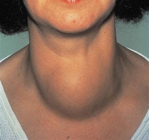 Зоб щитовидной железы фото