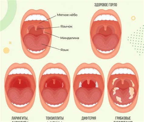 Как восстановить слизистую рта