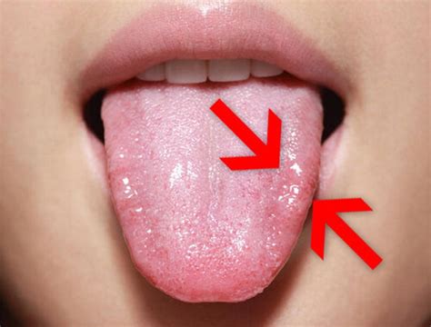 Почему болит язык по бокам