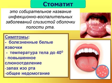 Стоматит у взрослых во рту